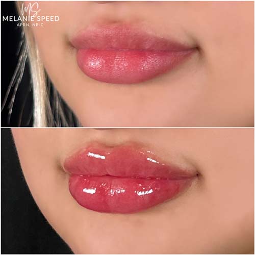 Lip Augmentation by Flawless Medspa