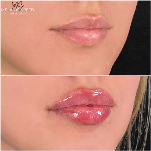 Lip Augmentation by Flawless Medspa