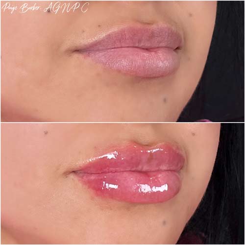 Lip Augmentation by Flawless Medspa