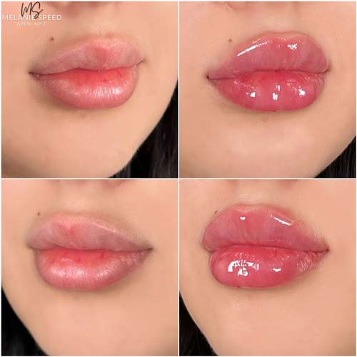 Lip Augmentation by Flawless Medspa