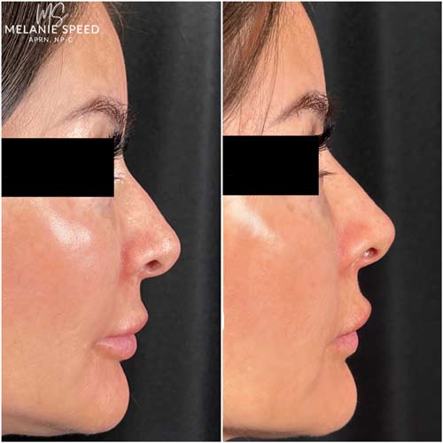 Nose Correction by Flawless Medspa