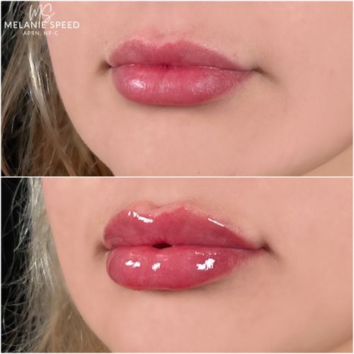 Lip Augmentation Before & After Photos by Flawless Medspa in Las Vegas NV