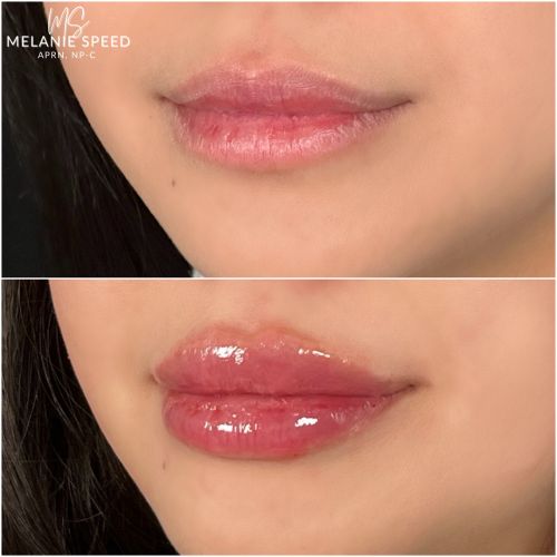 Lip Augmentation Before & After Photos by Flawless Medspa in Las Vegas NV