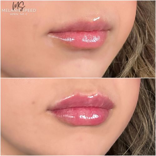 Lip Augmentation Before & After Photos by Flawless Medspa in Las Vegas NV