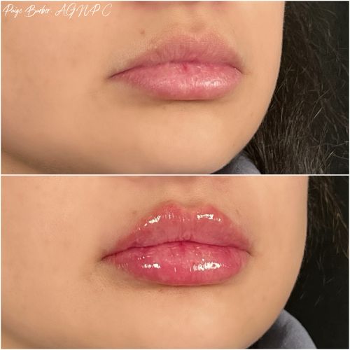 Lip Augmentation Before & After Photos by Flawless Medspa in Las Vegas NV