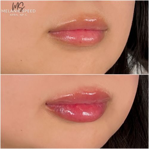 Lip Augmentation Before & After Photos by Flawless Medspa in Las Vegas NV