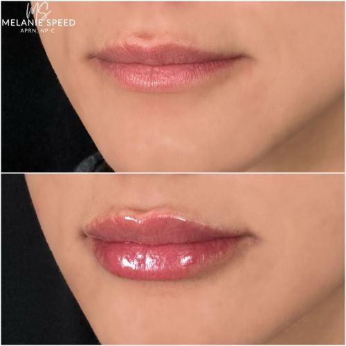 Lip Augmentation Before & After Photos by Flawless Medspa in Las Vegas NV