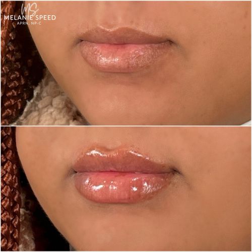 Lip Augmentation Before & After Photos by Flawless Medspa in Las Vegas NV