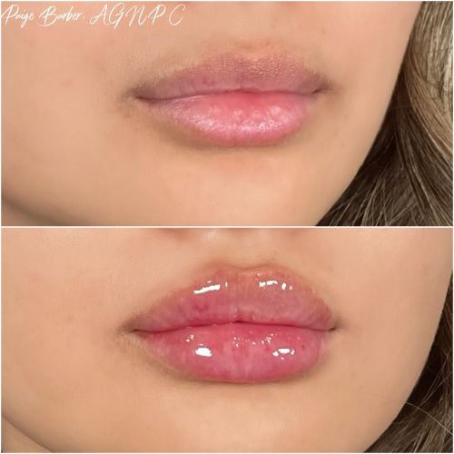 Lip Augmentation Before & After Photos by Flawless Medspa in Las Vegas NV