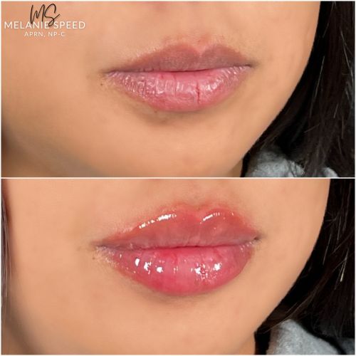 Lip Augmentation Before & After Photos by Flawless Medspa in Las Vegas NV