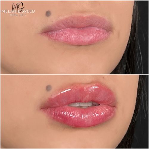 Lip Augmentation Before & After Photos by Flawless Medspa in Las Vegas NV