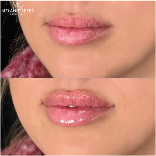 Lip Augmentation Before & After Photos by Flawless Medspa in Las Vegas NV