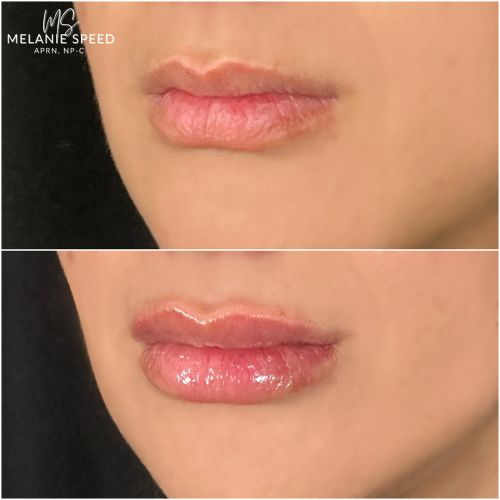 Lip Augmentation Before & After Photos by Flawless Medspa in Las Vegas NV