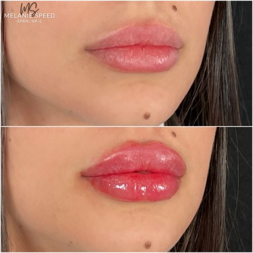 Lip Augmentation Before & After Photos by Flawless Medspa in Las Vegas NV