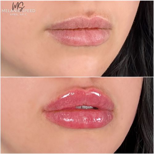 Lip Augmentation Before & After Photos by Flawless Medspa in Las Vegas NV