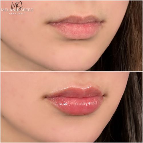 Lip Augmentation Before & After Photos by Flawless Medspa in Las Vegas NV