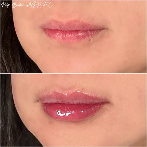 Lip Augmentation Before & After Photos by Flawless Medspa in Las Vegas NV