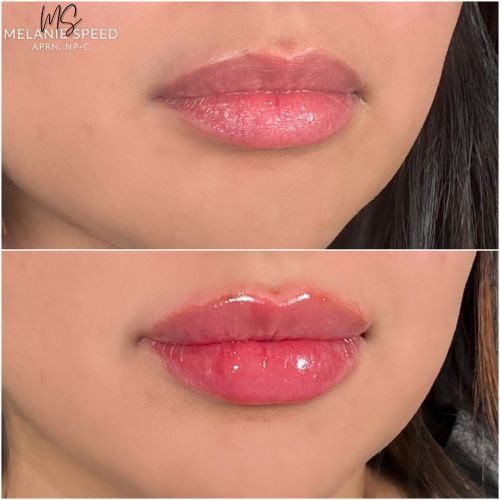 Lip Augmentation Before & After Photos by Flawless Medspa in Las Vegas NV