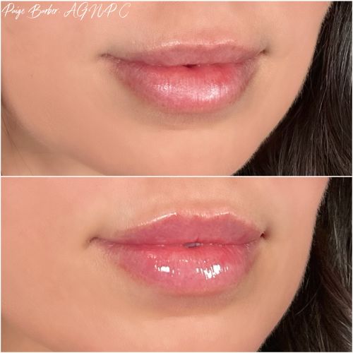 Lip Augmentation Before & After Photos by Flawless Medspa in Las Vegas NV