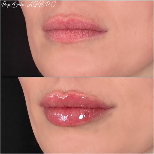 Lip Augmentation Before & After Photos by Flawless Medspa in Las Vegas NV