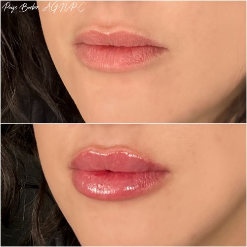 Lip Augmentation Before & After Photos by Flawless Medspa in Las Vegas NV