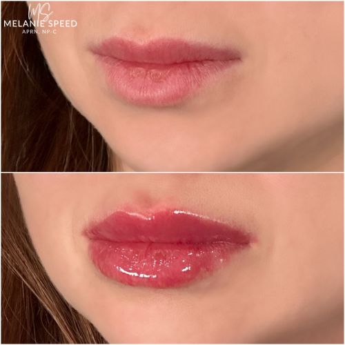 Lip Augmentation Before & After Photos by Flawless Medspa in Las Vegas NV