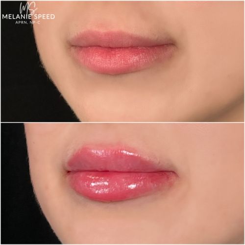 Lip Augmentation Before & After Photos by Flawless Medspa in Las Vegas NV