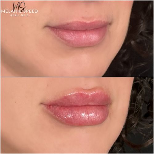 Lip Augmentation Before & After Photos by Flawless Medspa in Las Vegas NV