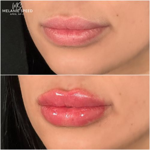 Lip Augmentation Before & After Photos by Flawless Medspa in Las Vegas NV