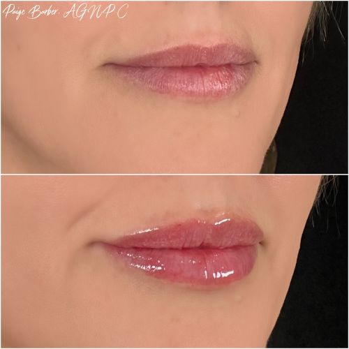 Lip Augmentation Before & After Photos by Flawless Medspa in Las Vegas NV