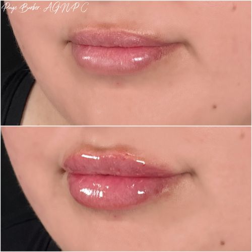 Lip Augmentation Before & After Photos by Flawless Medspa in Las Vegas NV