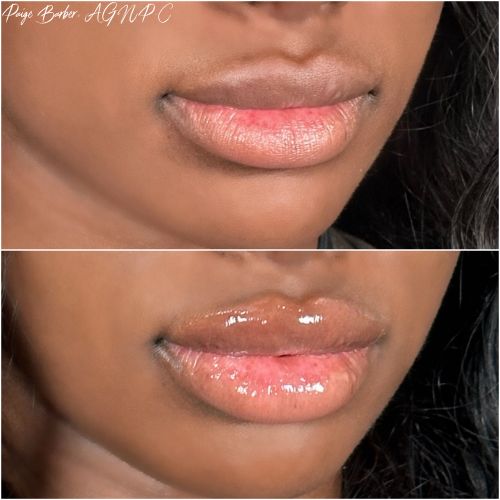 Lip Augmentation Before & After Photos by Flawless Medspa in Las Vegas NV