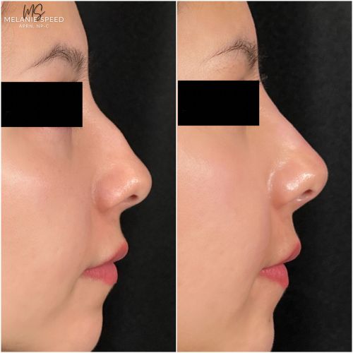 Nose Correction by Flawless Medspa