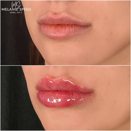 Lip Augmentation by Flawless Medspa