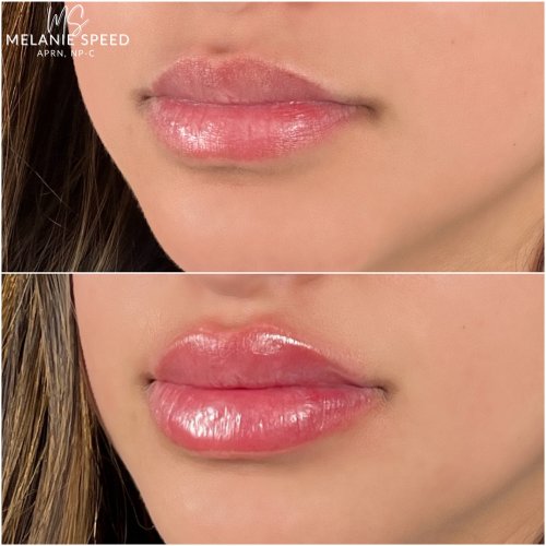 Lip Augmentation by Flawless Medspa