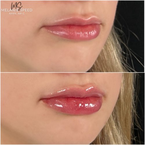 Lip Augmentation by Flawless Medspa