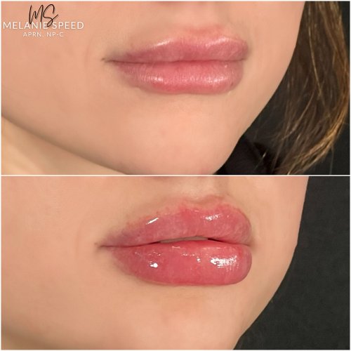 Lip Augmentation by Flawless Medspa