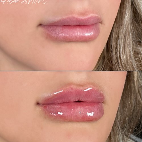 Lip Augmentation by Flawless Medspa