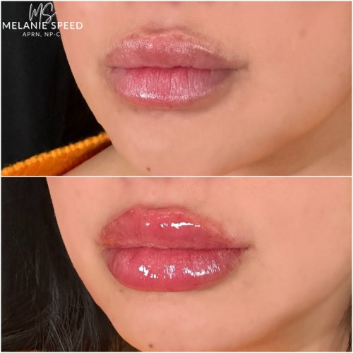 Lip Augmentation by Flawless Medspa