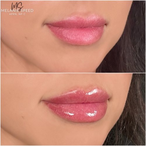 Lip Augmentation by Flawless Medspa