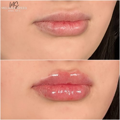 Lip Augmentation by Flawless Medspa