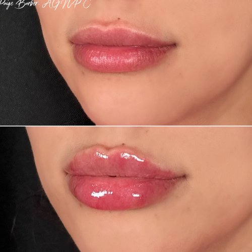 Lip Augmentation by Flawless Medspa