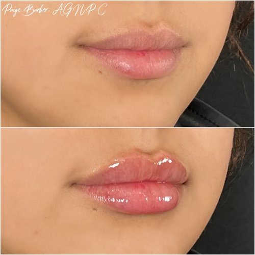 Lip Augmentation by Flawless Medspa