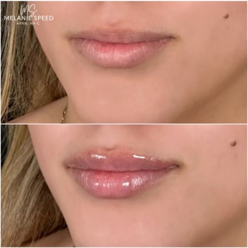 Lip Augmentation by Flawless Medspa