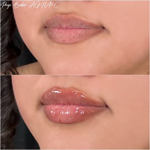 Lip Augmentation by Flawless Medspa