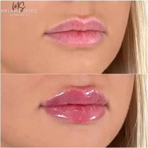 Lip Injections Before and After at Flawless MedSpa & The Beverly Hills MedSpa in Beverly Hills, CA and Las Vegas, NV Lip Injections Before and After at Flawless MedSpa & The Beverly Hills MedSpa in Beverly Hills, CA and Las Vegas, NV