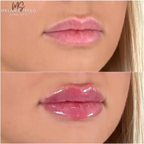 Lip Augmentation by Flawless Medspa