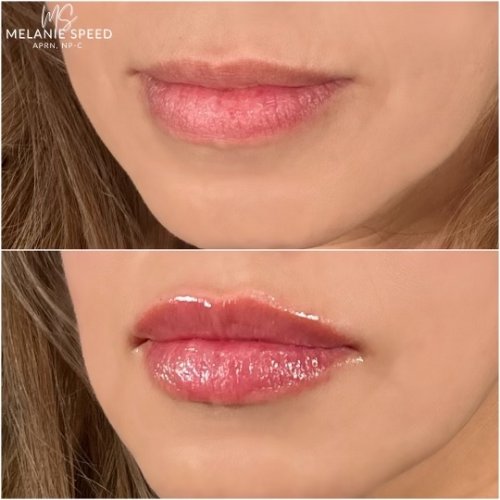 Lip Augmentation by Flawless Medspa