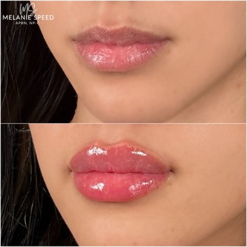 Lip Augmentation by Flawless Medspa