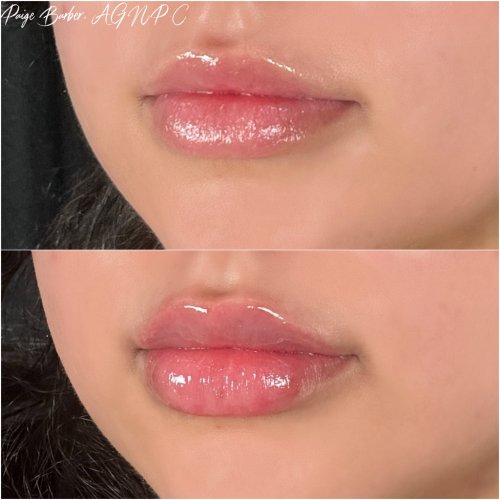 Lip Augmentation by Flawless Medspa